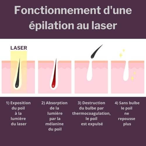explication du fonctionnement épilation laser peau noire