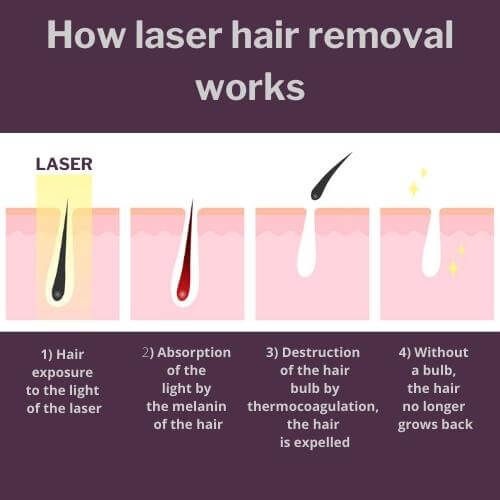 functionning hair removal laser YAG on black skin