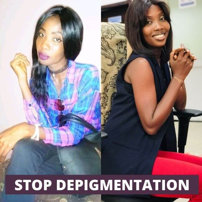 testimony stop depigmentation before after