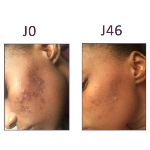 remove acne scars IN'OYA