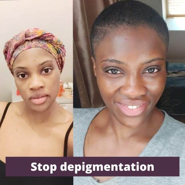 depigmentation black skin before after