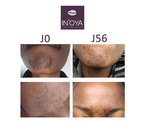 Résultats traitements taches & acnés sur peau noire