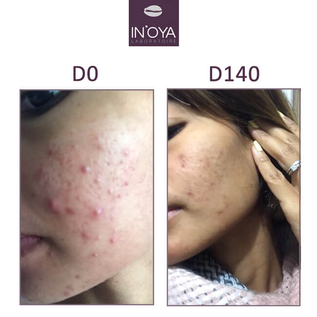 hormonal pimples and brown scarring before/after dark skin