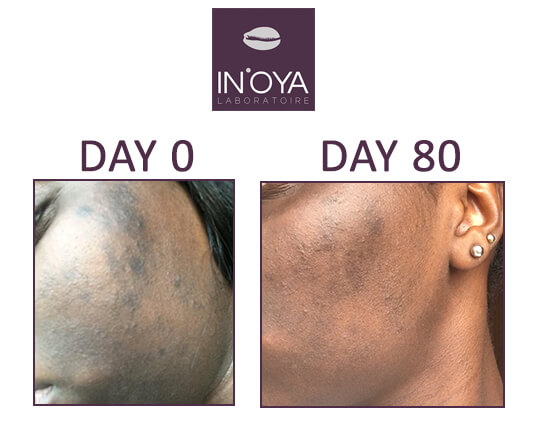 Results of spot treatments & acne on black skin