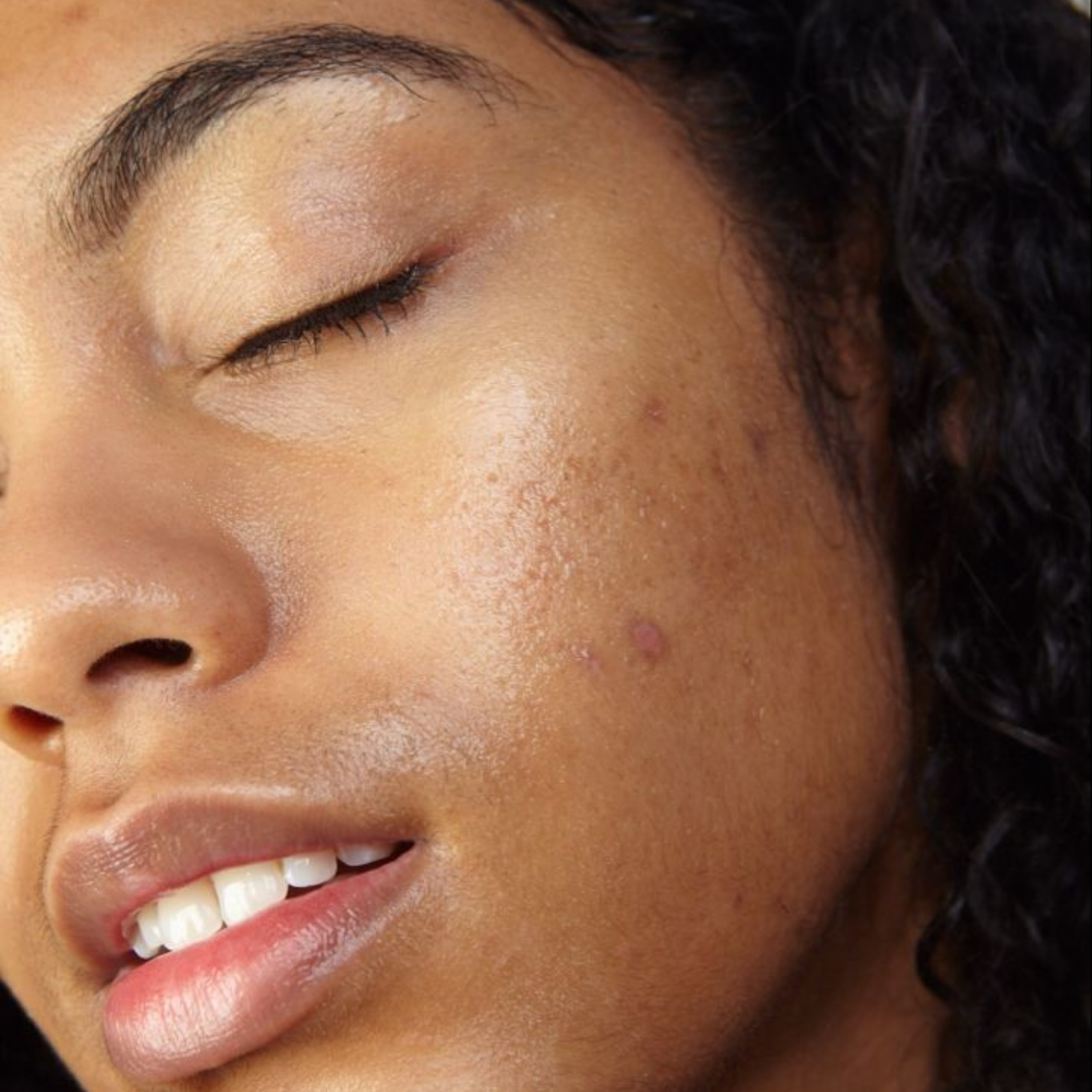 taches, hyperpigmentation