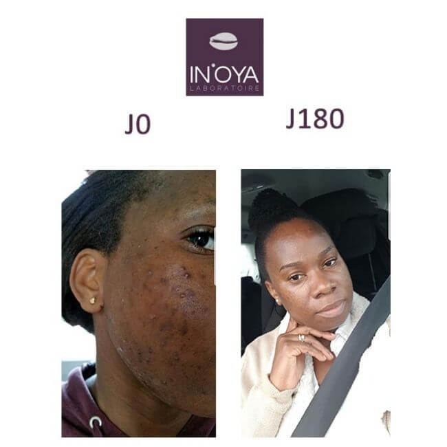 spots and pimples pregnancy black skin before/after