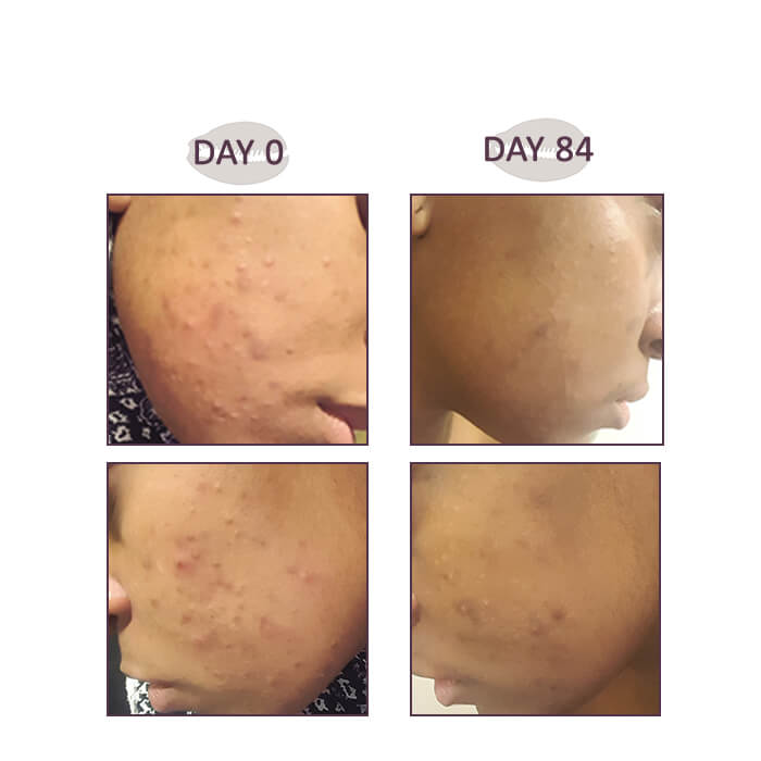 Results of spot treatments & acne on black skin