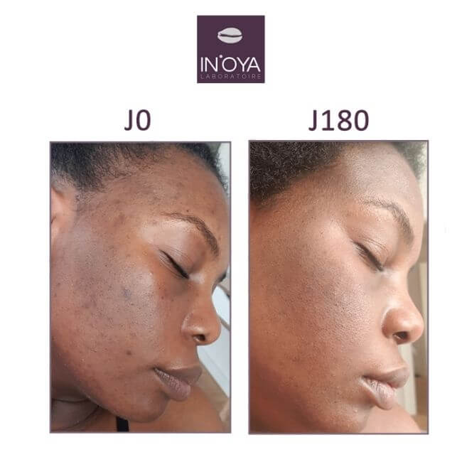 brown spots scars pimples before/after