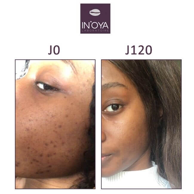 dark spot on black face before / after