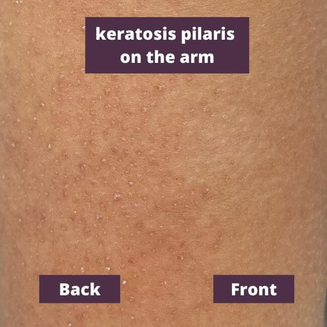 keratosis pilaris on the arm black skin