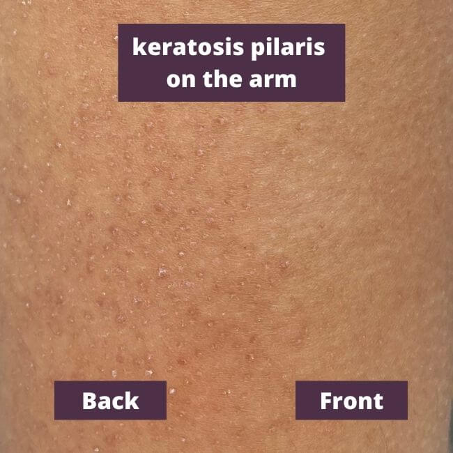 Keratosis pilaris, Dark armpits, Dark inner thighs,Dark spots gone sup