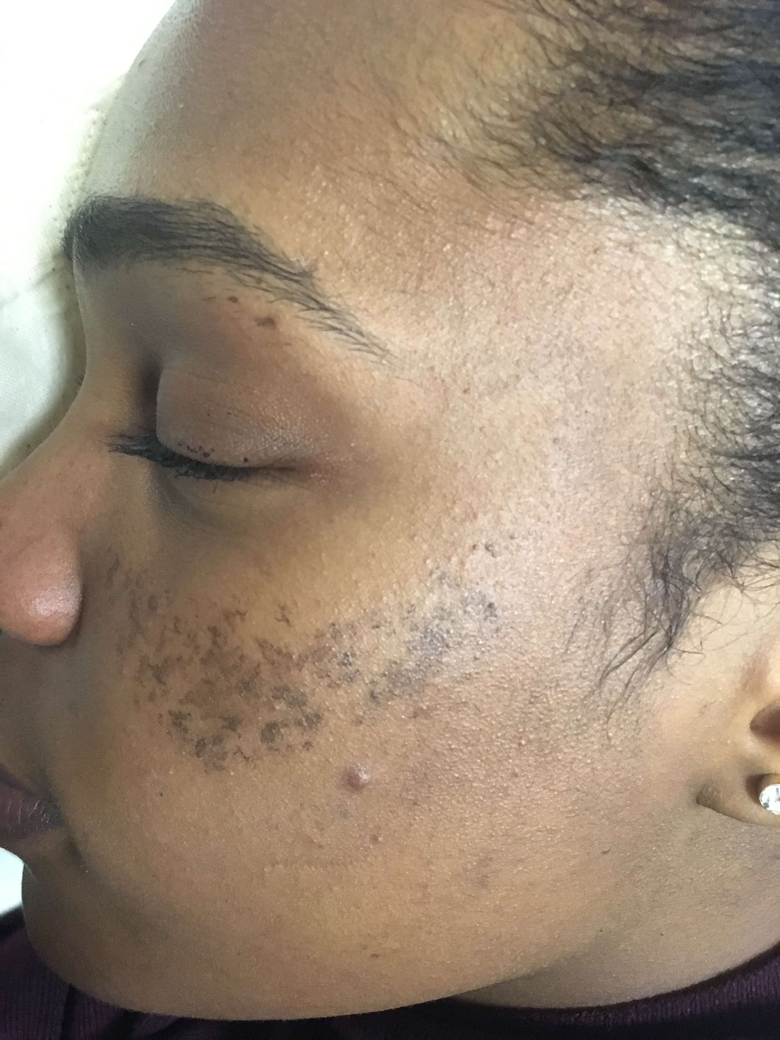 Melasma on Black Skin 