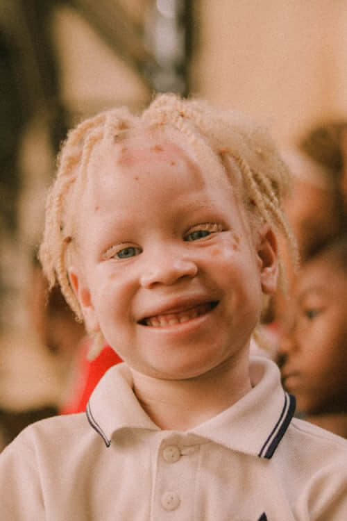 Albinos enfant africain