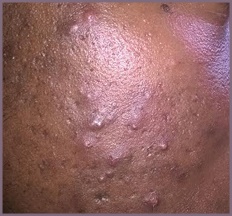Excellent results from the first month of treatment