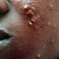 Ibrahim, 23 years old - Acne Pimple Treatment