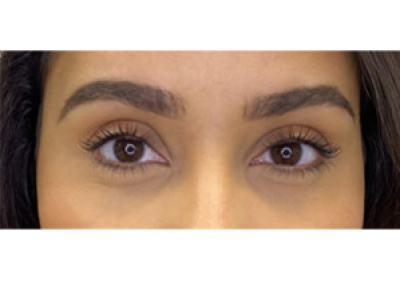 HOW TO FIGHT AGAINST DARK CIRCLES ?