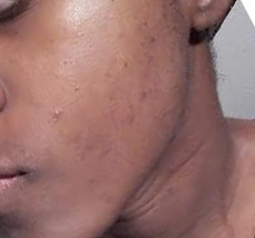 I am impressed by the significant improvement of my spots