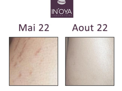 Hazra, 27 ans : Vergetures sur peau mate et métissée