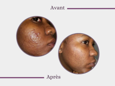 Pimples on her face - Samianti