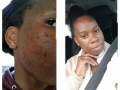 Pregnacy dark spot and pimples - Sandra, 31 yo