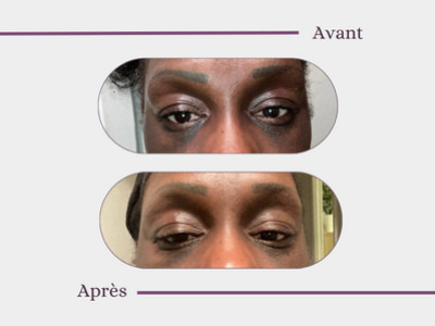 Dark circles under the eyes: Adèle's solution, 46 yo