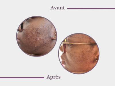 Post-pregnancy mask treatment - Bérylle, 29 yo
