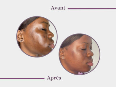 Sun exposure: How I removed my spots - Maimouna, 27 yo