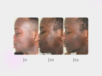 How I got my skin back after a depigmentation ? - Jean Philippe, 29 yo