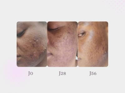 Charlène's anti-blemish solution