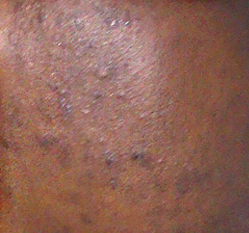 I was desperate thinking I would never have a beautiful skin