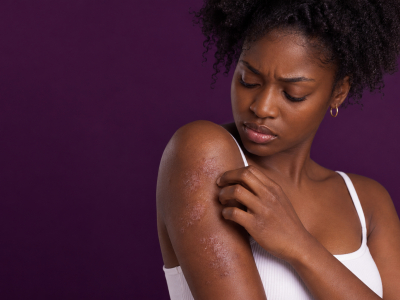 Psoriasis sur peau noire : reconnaître les signes et les traitements