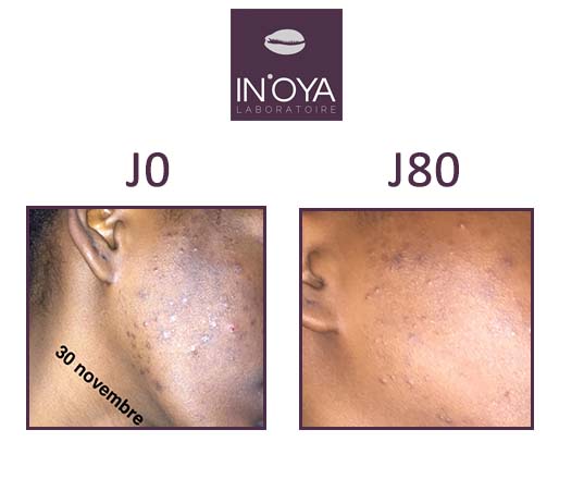 Aminata, 21 years old: Black spots and pimples on the face