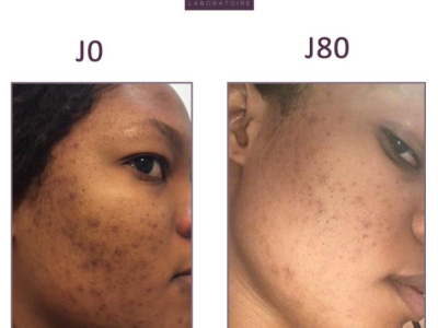 Lya, 26: Stubborn black spots on the face