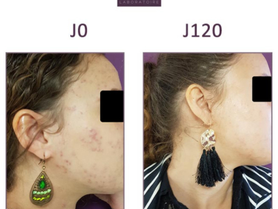 Cecilia, 23: Big pimples on her matte skin