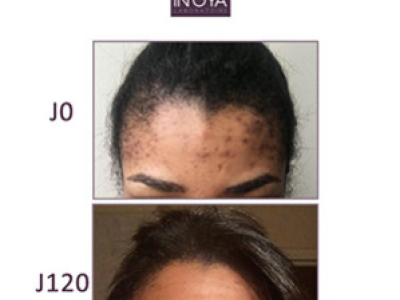 Amandine, 27 years old: Black spots and pimples on the face