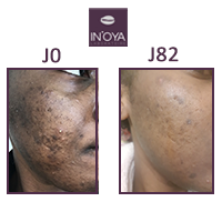 Karen, 28 years old: Black spots and pimples on the face