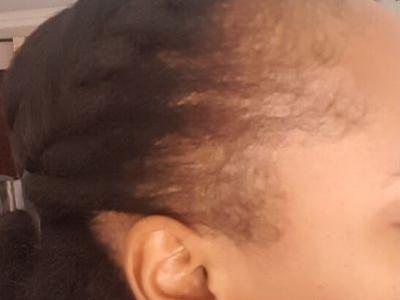 Comprendre la chute des cheveux afro et la traiter ? 