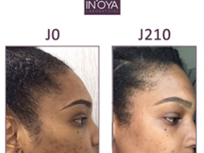 Syndie, 30 years old: Black spots and pimples on the face