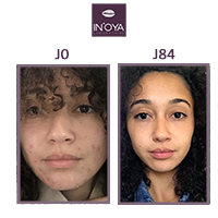 Louise, 25 ans : Taches noires et boutons sur le visage