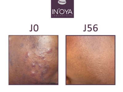 Meryem, 24 years old, Morocco - anti-stain serum review