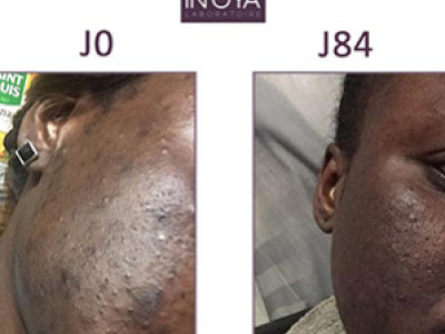 fatou-32-hormonal-spot-and-pimples