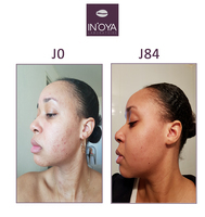 Saida, 26 years old: Pimples on the face