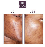 Linda, 40 ans : Taches noires et boutons sur le visage