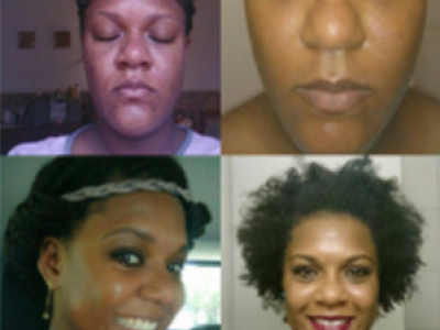 Esther - Pimples and spots following her pregnancy