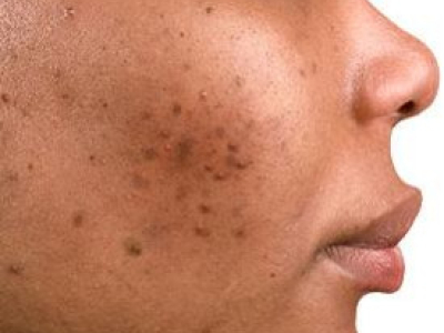 Say goodbye to spots and acne!