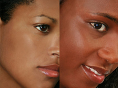 The Pigmentation of Black Skin: Hyperpigmentation...
