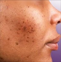 Acne & Black Skin: Causes, Treatments, Tips