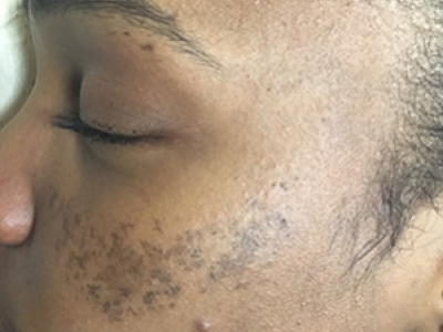 How to Treat Pregnancy Mask on Black Skin| INOYA