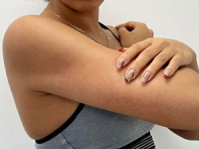KERATOSIS PILARIS : FOCUS ON BLACK AND BROWN SKIN