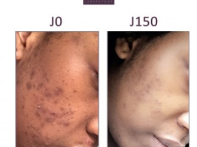 Touléma, 21 ans : Taches noires et boutons sur le visage